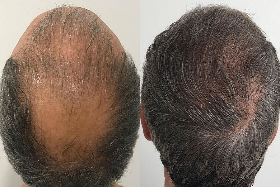 HairTransplant-by-medical-tour